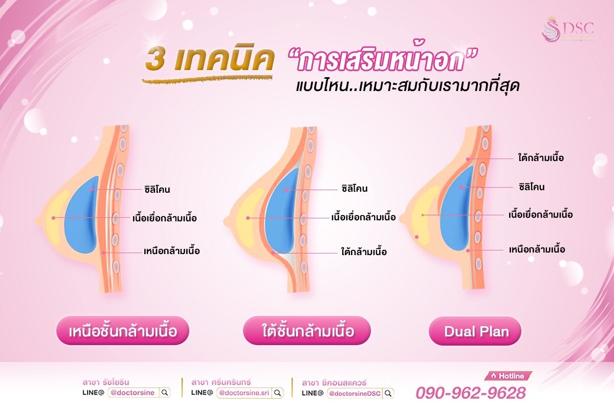 เทคนิคการผ่าตัดเสริมหน้าอก แบบไหนที่เหมาะสำหรับคุณ..?
