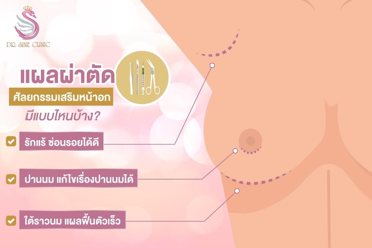 ตำแหน่งของ ‘แผลผ่าตัดเสริมหน้าอก’ 
