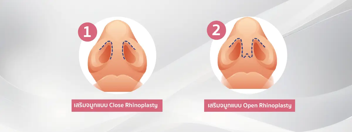 เสริมจมูก ข้อดี ข้อเสีย